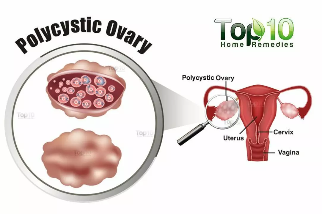 The role of gemfibrozil in managing cholesterol levels in patients with polycystic ovary syndrome (PCOS)